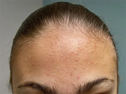 Acne em adolescentes