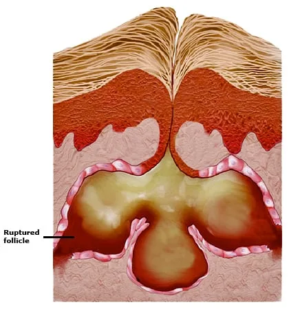 Inflamm_follicle_PI