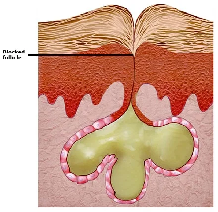 Shedding_epithelial_cell_PI