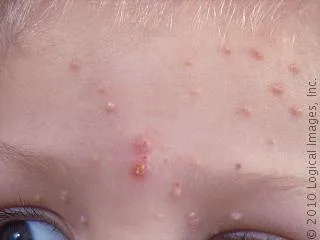 Molusco contagioso