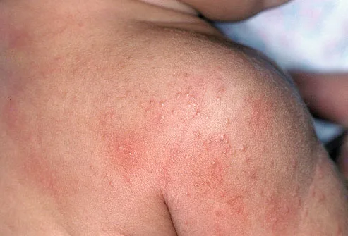 miliaria rubra