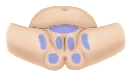 Assaduras