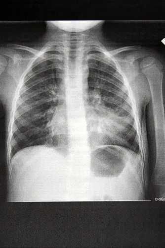 Pneumonias