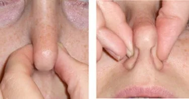 Epistaxe ou sangramento nasal